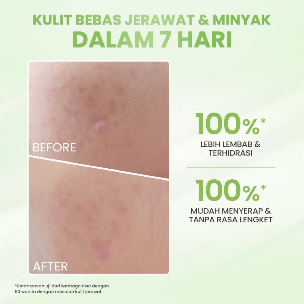 hanasui acne expert night cream 15g/pelembab wajah berjerawat hanasui acne expert night cream 15g/pelembab wajah berjerawat