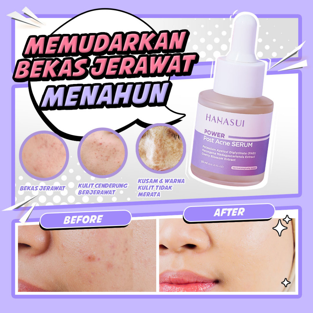 hanasui power post acne serum 20ml/serum jerawat hanasui power post acne serum 20ml/serum jerawat